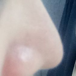 Nâng mũi hơn 8 năm có gây ra viêm xoang/viêm mũi không?