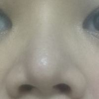Nâng mũi hơn 8 năm có gây ra viêm xoang/viêm mũi không? Nâng mũi hơn 8 năm có gây ra viêm xoang/viêm mũi không?