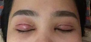 Sau cắt mí 3 ngày: hai bên mí không đều