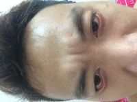 cắt mi dưới