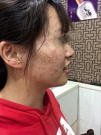 Từng bị chê bai vì má đầy mụn, cô gái đã thay đổi như thế này đây