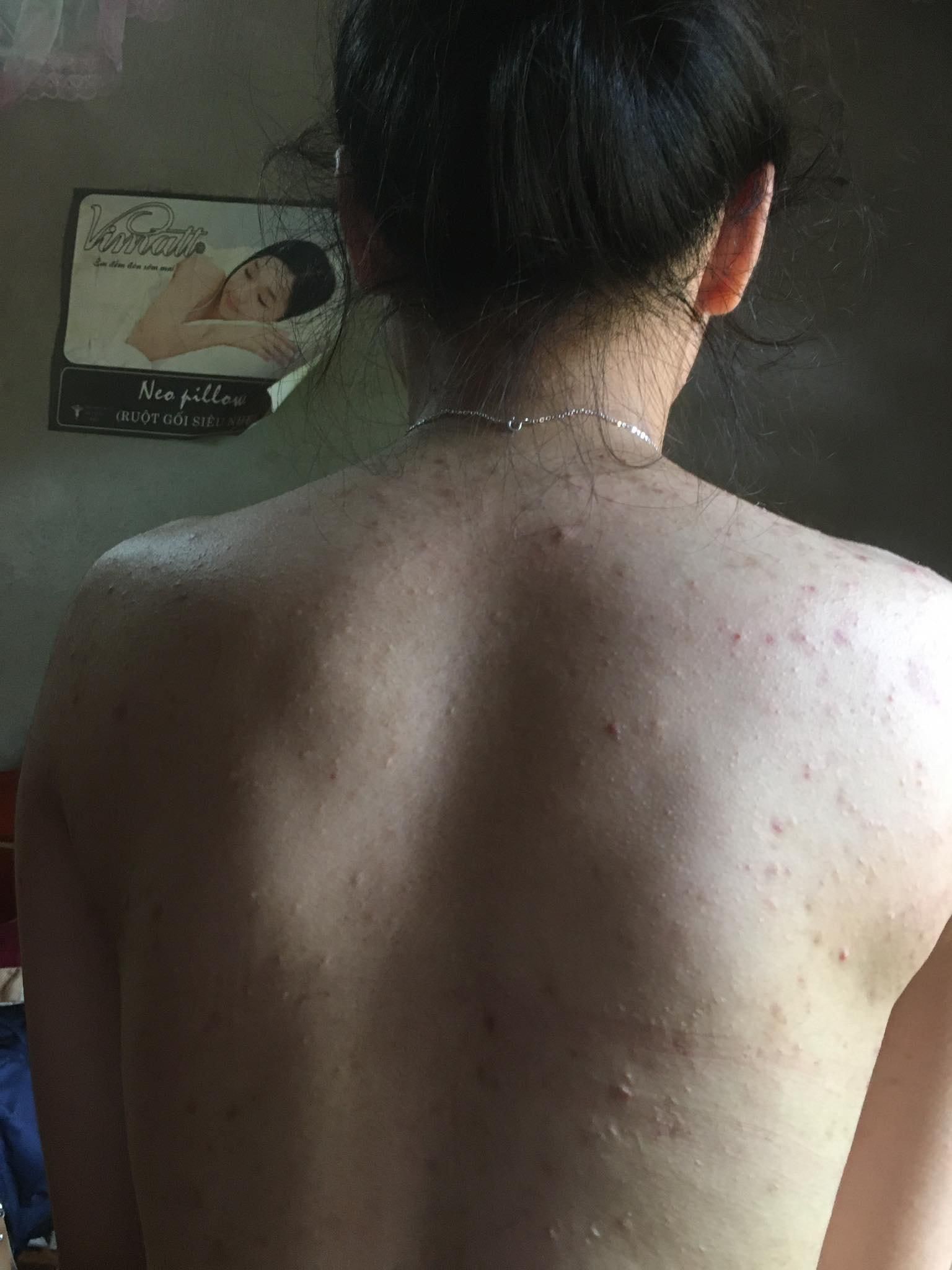 Từ cô nàng mụn lưng hóa thành hot girl gợi cảm nhờ đâu?