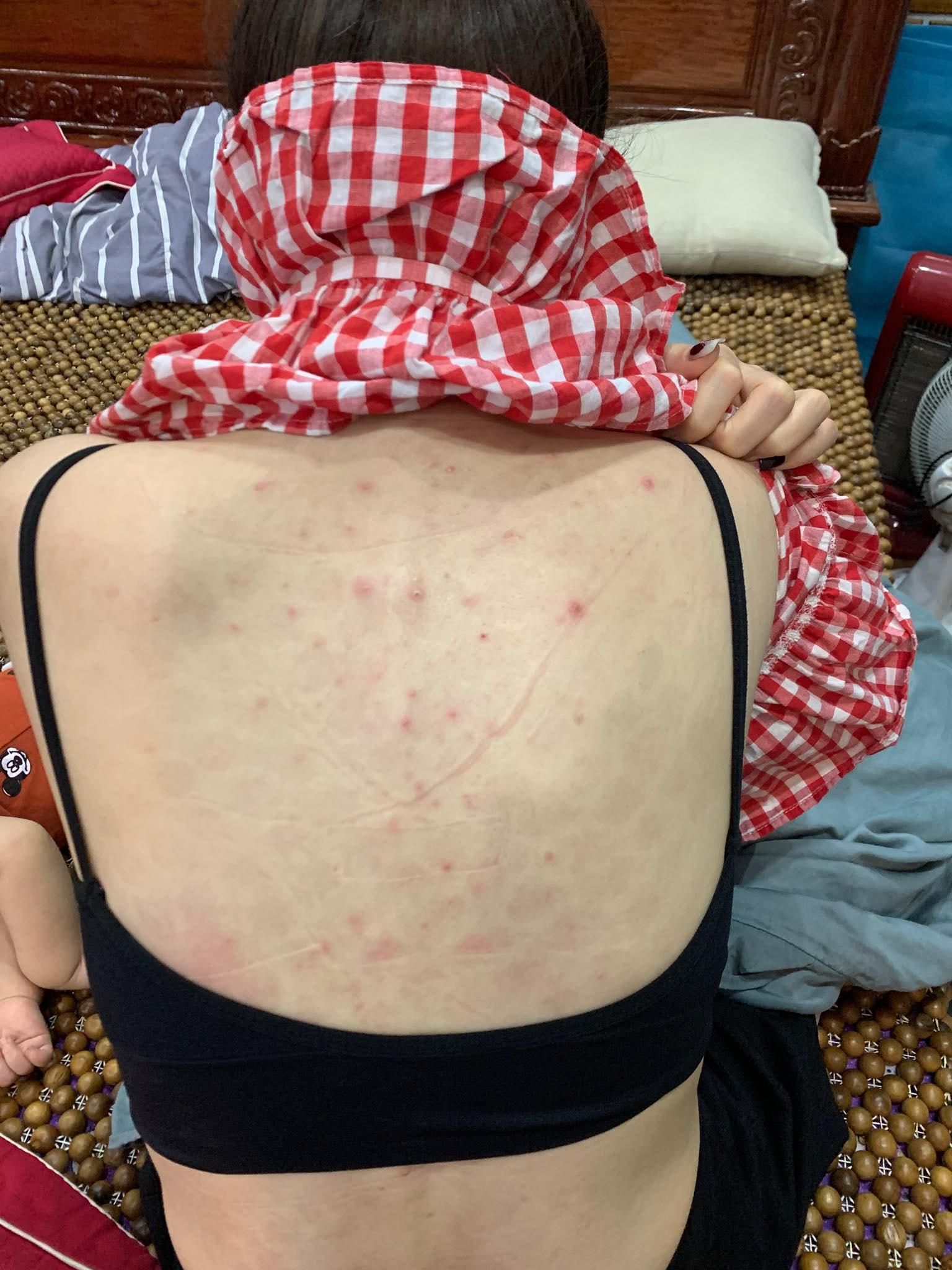 Tôi đã chia tay mối tình đầy tiếc nuối chỉ vì mụn lưng, ngực