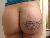 Bầm tím và đau kéo dài nhiều tháng sau đặt túi độn mông