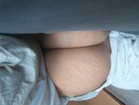 Da nhạy cảm và bị rạn nặng sau khi đặt túi độn mông: tháo bỏ túi độn liệu có khiến mông chảy xệ?