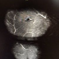 Mông bị đau và xuất hiện vết lõm sau 5 năm đặt túi độn