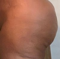 Đặt túi độn mông có giúp loại bỏ da sần vỏ cam và u cục lổn nhổn do nhiều lần cấy mỡ mông không?