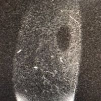 Mông bị đau và xuất hiện vết lõm sau 5 năm đặt túi độn