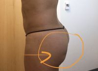 Mông bị đau và xuất hiện vết lõm sau 5 năm đặt túi độn