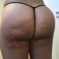 Mông bị đau và xuất hiện vết lõm sau 5 năm đặt túi độn