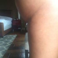 Nếu tháo bỏ túi độn thì có cần nâng mông chảy xệ không?