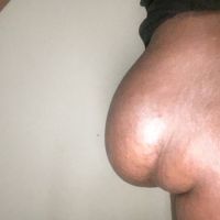 Túi độn mông bị chảy xệ và dịch chuyển: phải xử lý như nào?