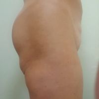 Đã đặt túi độn và cấy mỡ mông nhưng mông dưới vẫn bị chảy xệ, xuất hiện cuộn mỡ