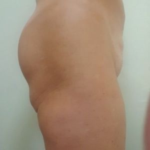 Đã đặt túi độn và cấy mỡ mông nhưng mông dưới vẫn bị chảy xệ, xuất hiện cuộn mỡ