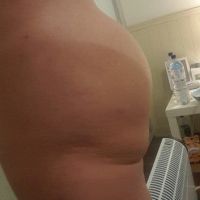 Đã đặt túi độn và cấy mỡ mông nhưng mông dưới vẫn bị chảy xệ, xuất hiện cuộn mỡ