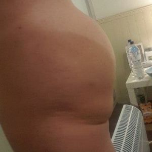 Đã đặt túi độn và cấy mỡ mông nhưng mông dưới vẫn bị chảy xệ, xuất hiện cuộn mỡ