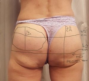 Đã đặt túi độn và cấy mỡ mông nhưng mông dưới vẫn bị chảy xệ, xuất hiện cuộn mỡ