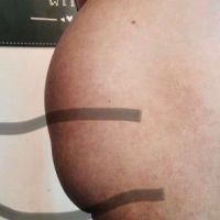 Mông dưới bị lõm, nhỏ sau khi đặt túi độn