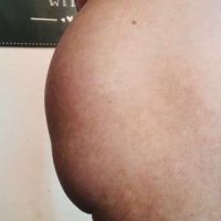 Mông dưới bị lõm, nhỏ sau khi đặt túi độn