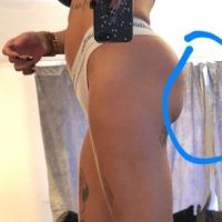 Mông dưới bị lõm, nhỏ sau khi đặt túi độn