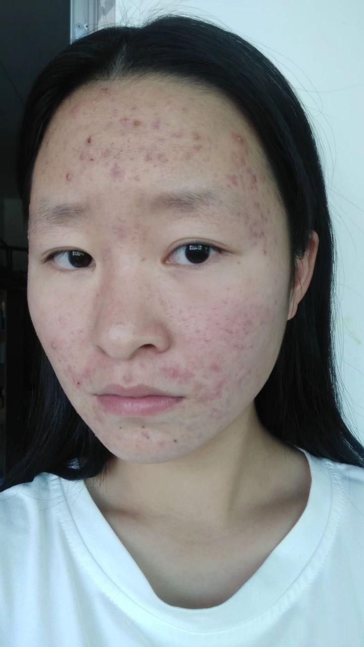 Cô gái mất ngủ cả đêm khi nằm cạnh người yêu vì lo bị mụn