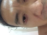 cắt mi dưới