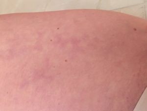 Bầm tím kéo dài không hết dù đã 18 tháng sau hút mỡ và tạo hình thành bụng mini