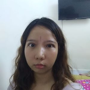 Mắt em cắt được 2 tháng đã hết sưng nề nhưng vẫn bị co rút nên trợn