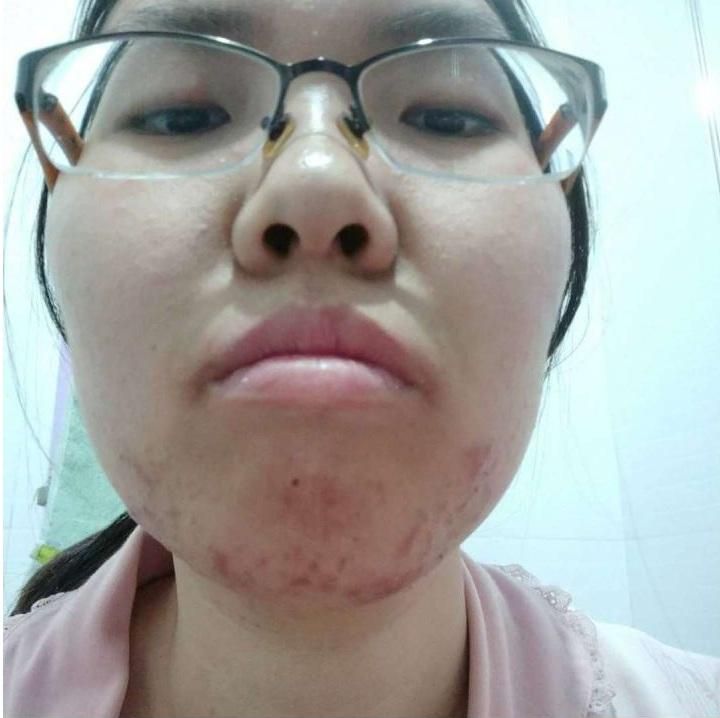 Từng bị chê bai vì má đầy mụn, cô gái đã thay đổi như thế này đây