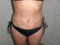 Da nhăn sau tạo hình thành bụng mini và hút mỡ