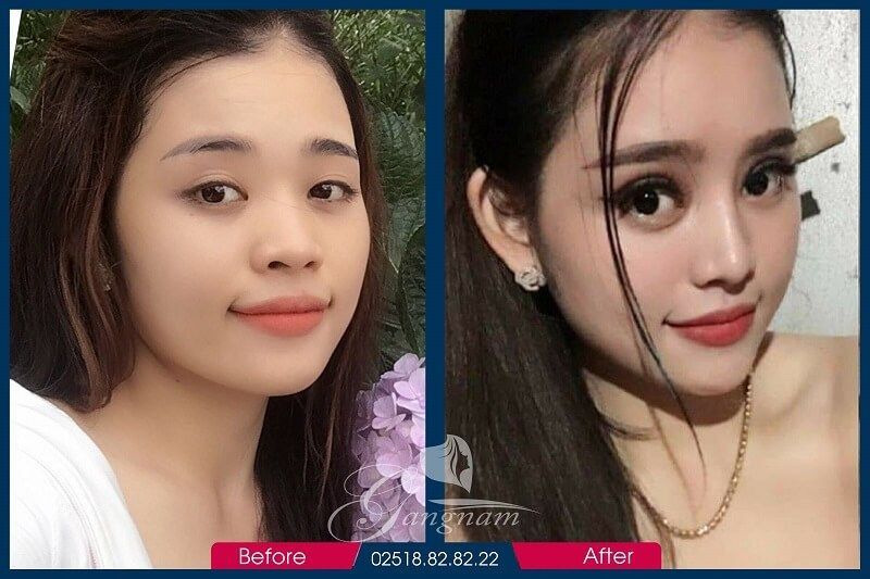 Nâng mũi bọc sụn