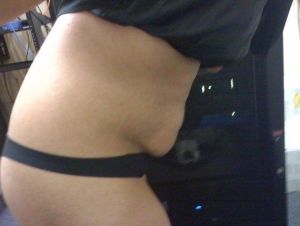 Thắc mắc về việc loại bỏ vết rạn da bằng phẫu thuật tạo hình thành bụng