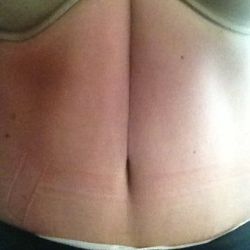 Tại sao bụng tôi lại có nếp gấp dọc sau tạo hình thành bụng kèm thắt cơ?