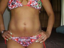 Sẹo mổ đẻ: Nên chọn tạo hình thành bụng hay phẫu thuật chỉnh sửa sẹo?