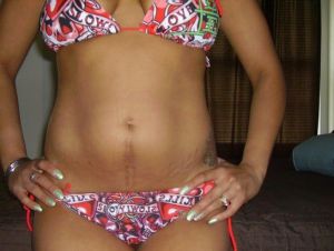 Sẹo mổ đẻ: Nên chọn tạo hình thành bụng hay phẫu thuật chỉnh sửa sẹo?