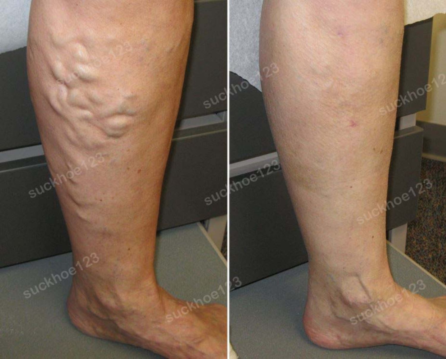 suy gian tinh mach chan truoc sau dieu tri