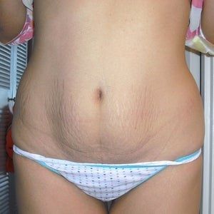 Chỉ có ít da thừa ở bụng thì có thể tạo hình thành bụng mini không?