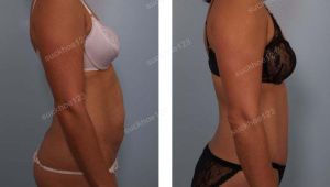 Tạo hình thành bụng kết hợp hút mỡ, nữ 40 tuổi - ca 1