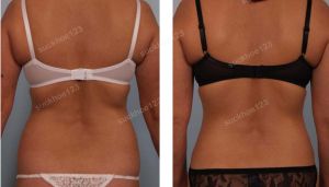 Tạo hình thành bụng kết hợp hút mỡ, nữ 40 tuổi - ca 1