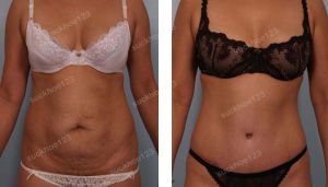 Tạo hình thành bụng kết hợp hút mỡ, nữ 40 tuổi - ca 1