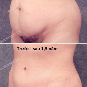 Tạo hình thành bụng, nữ 34 tuổi bụng nhô sau 4 lần sinh con - ca 10