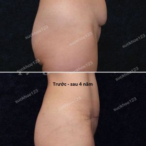 Tạo hình thành bụng & hút mỡ ụ hông, nữ 36 tuổi có sẹo sinh mổ co kéo - ca 11