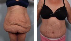 Tạo hình thành bụng, nữ 42 tuổi da chảy xệ do giảm cân số lượng lớn - ca 12