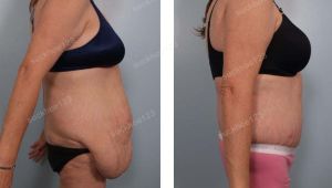 Tạo hình thành bụng, nữ 42 tuổi da chảy xệ do giảm cân số lượng lớn - ca 12