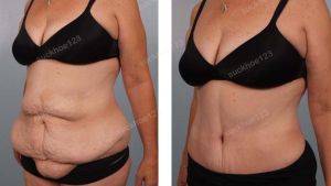 Tạo hình thành bụng kết hợp hút mỡ hông eo, nữ 49 tuổi - ca 2