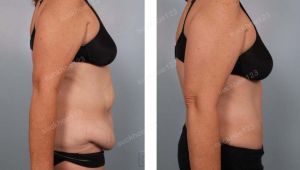 Tạo hình thành bụng kết hợp hút mỡ hông eo, nữ 49 tuổi - ca 2