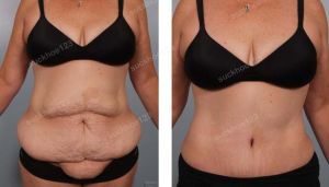 Tạo hình thành bụng kết hợp hút mỡ hông eo, nữ 49 tuổi - ca 2