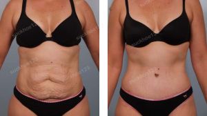 Tạo hình thành bụng kết hợp hút mỡ hông eo & hút mỡ đùi, nữ 35 tuổi - ca 3