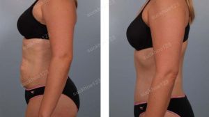 Tạo hình thành bụng kết hợp hút mỡ hông eo & hút mỡ đùi, nữ 35 tuổi - ca 3