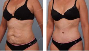 Tạo hình thành bụng kết hợp hút mỡ hông eo & hút mỡ đùi, nữ 35 tuổi - ca 3